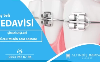 Kayseri diş teli
