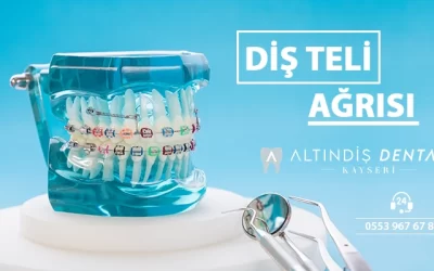 Diş teli acıtır mı ? Diş teli ağrısı
